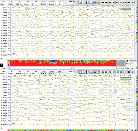 A Eeg Showing Periodic Epileptiform Discharges Involving Left