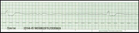 Float Nurse: EKG Rhythm Strips 91 Various Agonal Rhythms