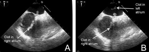 Transesophageal Echocardiography Midesophageal Bicaval View