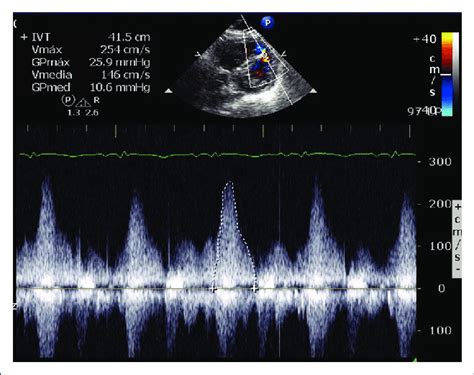 Ecocardiograma Transtorácico Bidimensional Y Con Doppler A Color Que