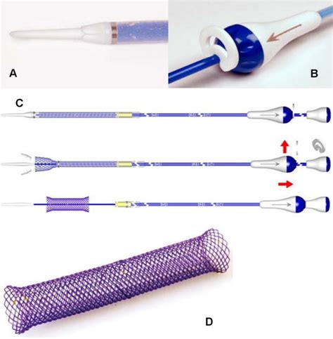 Stent Delivery System A Olive Tipsheath B Sheath Handle C Stent Download Scientific Diagram