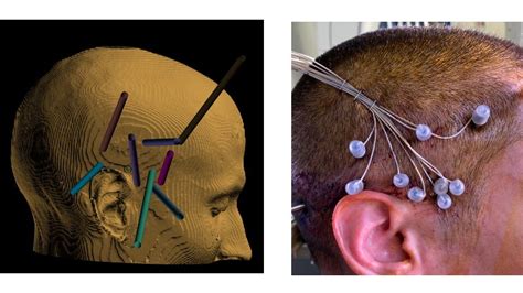 Stereotactic EEG SEEG Matthew Mian MD