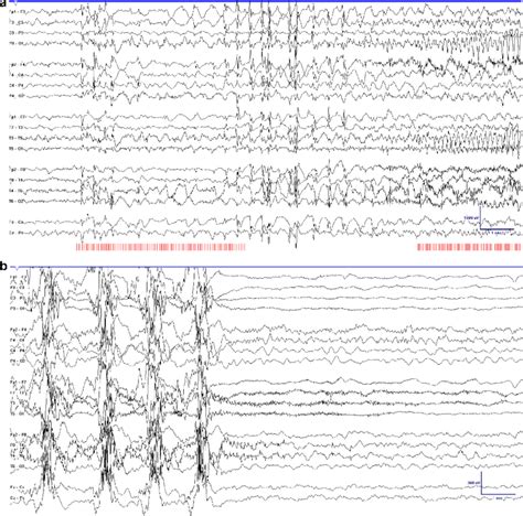 Postictal Unilateral Eeg Suppression After A Provoked Secondarily