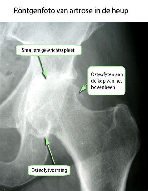 Artrose Heup Coxartrose Symptomen Behandeling Oefeningen