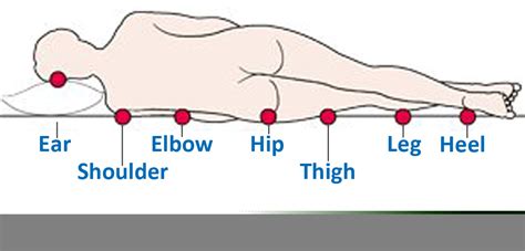 Pressure Ulcer Cartoon