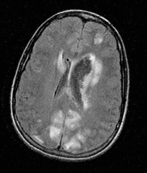 A Mri Brain Axial Flair Image 90022200 132 Increased Foci Of High