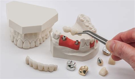 Zirconia Dental Implants Vs Titanium Implants Which Is Better For Your