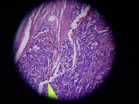 Congo Red Staining Of Thyroid Medullary Carcinoma Show Stromal Amyloid Download Scientific