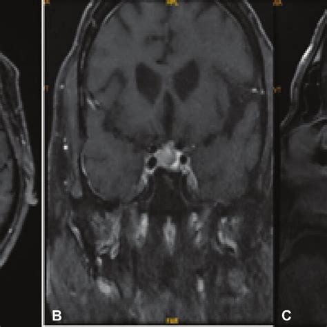 Magnetic Resonance Imaging Mri Brain Contrast In October 2018