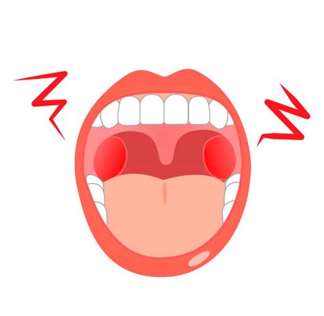 100+ Throat Ulcer Stock Illustrations, Royalty-Free Vector Graphics ...