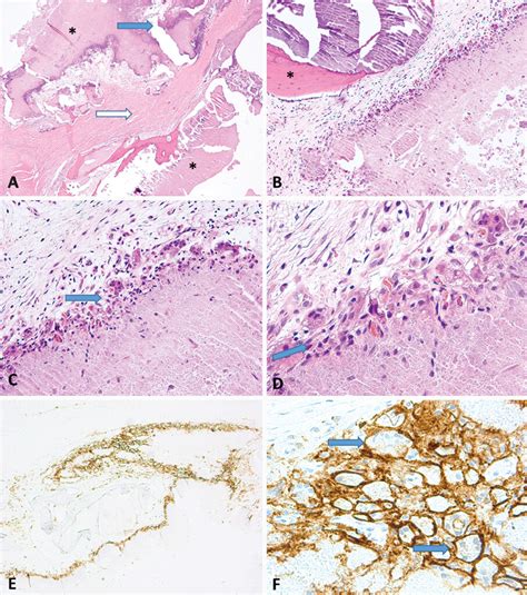 Navigation Assisted Resection Of Tumoral Calcinosis Of The Lumbosacral