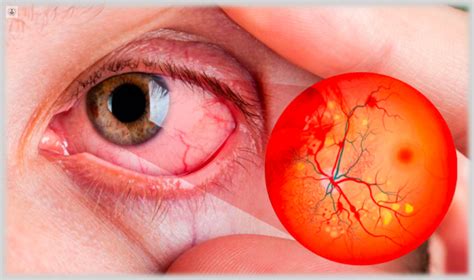 Retinopatía Diabética Síntomas y tratamientos para tratarla Top Doctors