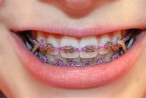 How Do Rubber Bands On Braces Help Marisol Edgar