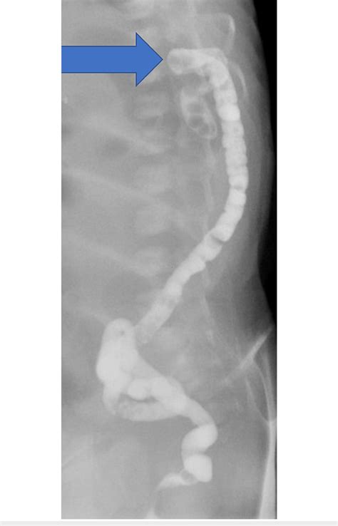 Contrast Gastrografin Enema Showing That The Caliber Of The Rectum