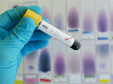 Nových případů HIV v Česku v 1. čtvrtletí meziročně o třetinu ubylo ...