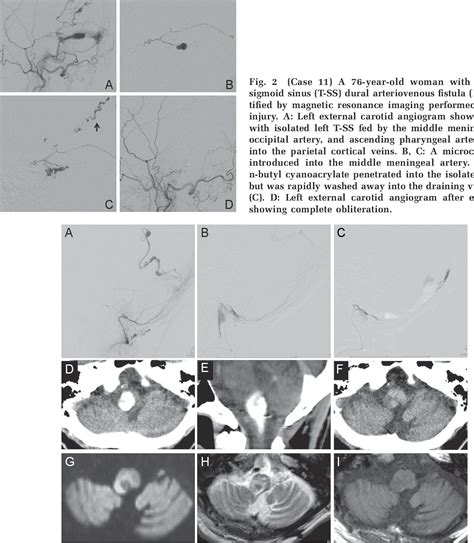 Figure From Efficacy And Limitations Of Transarterial Acrylic Glue