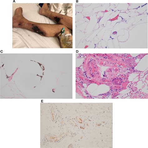 Thrombotic retiform purpura (clinical features). (A), (B) Patients had ...