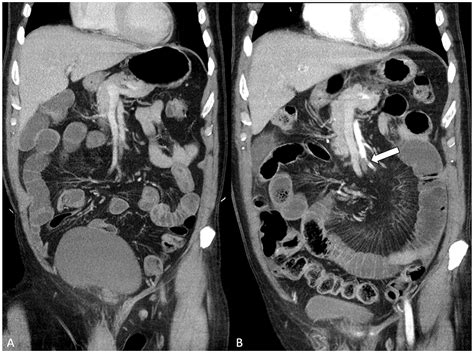 Acute Mesenteric Ischemia A Challenge For The Acute Care Surgeon J