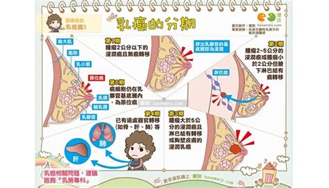 【抗癌調養懶人包】圖解乳癌分期 健談 康健名家觀點