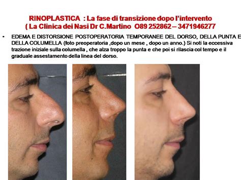 Rinoplastica La Fase Di Transizione Post Operatoria