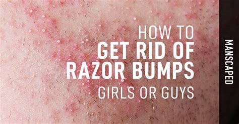 How To Get Rid Of Razor Bumps Girls Or Guys Manscaped™ Blog