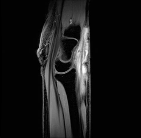 Tuberculous Tenosynovitis Image