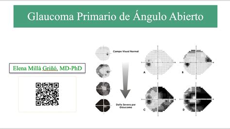 Glaucoma Primario De Ngulo Abierto Youtube