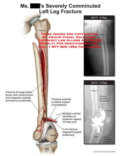 Amicus Illustration Of Amicus Injury Leg Comminuted Fracture Left Femur