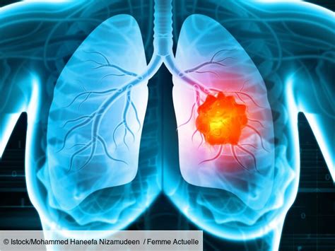 Traitements Du Cancer Du Poumon Comment Se Soigne T Il Selon Le Stade