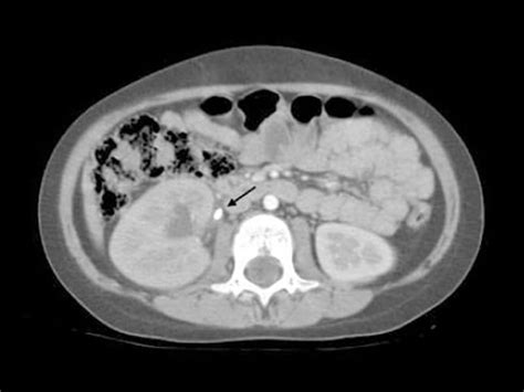 X Ray Or Ct Scan For Kidney Stone