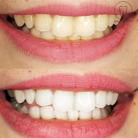 Before After Teeth Whitening by Smile Concept dental clinic ...