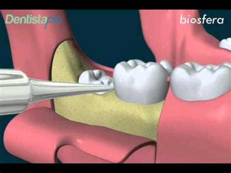 Estrazione Del Dente Del Giudizio In Inclusione Ossea Parziale YouTube