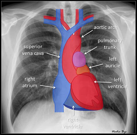 Cardiac Silhouette On Pa Chest Radiography By Nadiabys On Deviantart