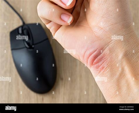 Redness And Callus Or Corn On The Wrist Of A Caucasian Womans Hand