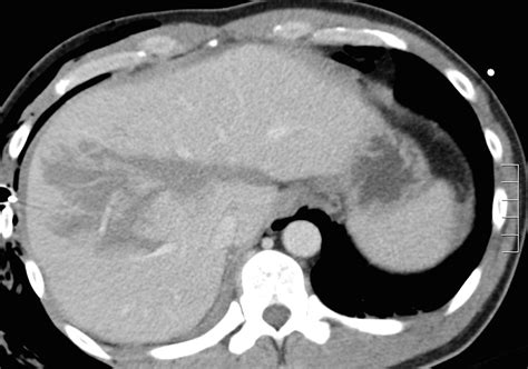 Liver Laceration Radiology At St Vincents University Hospital