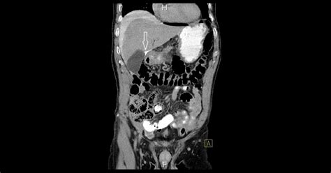 Perforated Duodenal Ulcer - Manal's Classroom