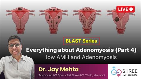 Blast Series Everything About Adenomyosis Part 4 Low Amh And