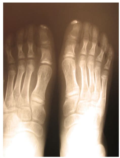 Distal Calcinosis In A Patient With Juvenile Systemic Sclerosis