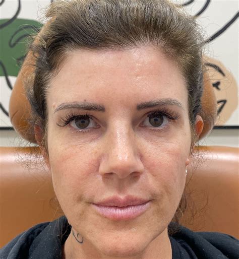 Lower Face Filler In El Dorado Hills Esthetics Center