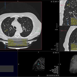 Automatic Segmentation Of A Pulmonary Nodule Identified On Chest CT By