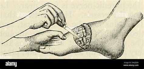 amputation foot toe  res stock photography  images alamy