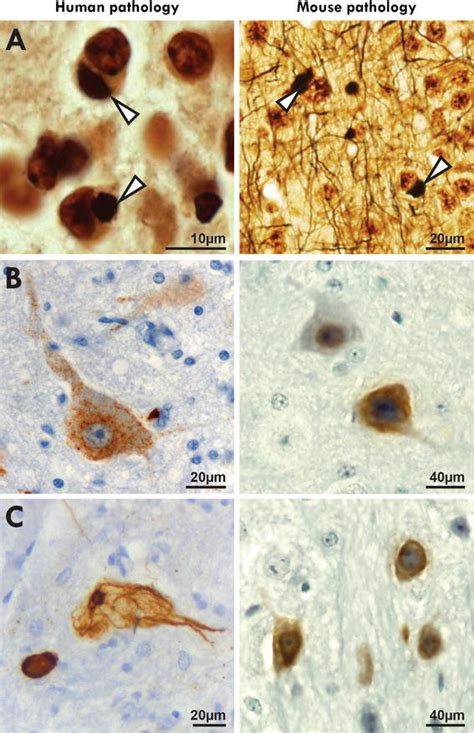 A Comparison Of The Pathology Observed In Patients And Mouse Models Of