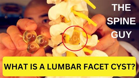 What Is A Lumbar Facet Cyst Youtube