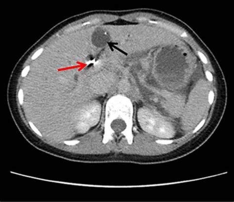 Ct Scan Showing Biliary Cystadenoma The Cystic Lesion Open I