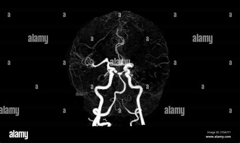 CT Angiography Of The Brain Medical Technology Concept Stock Photo