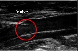 Ultrasound images A) the transverse image of the popliteal vein and ...