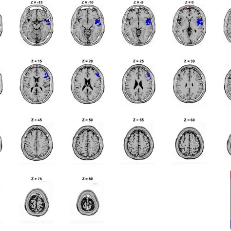 Sloreta Localizations Source Estimations Of Significant Effects