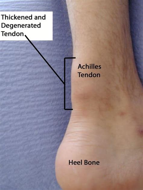 Sprains Strains And Other Soft Tissue Injuries Orthoinfo Aaos