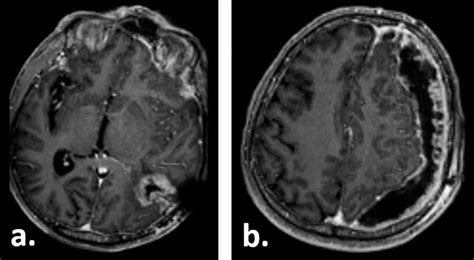 Gadolinium Enhanced T Weighted Axial Mri Of The Patient Weeks After