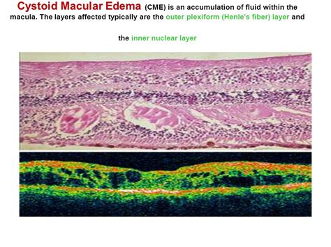 Cystoid Macular Edema Histology